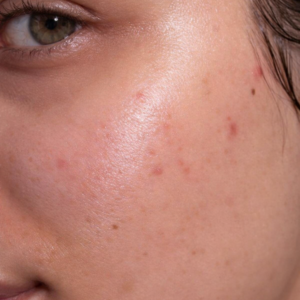 Blemish & Enlarged Pores