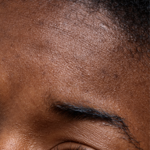 Dry & Dehydrated Skin