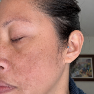 Hyperpigmentation & Dark Spots